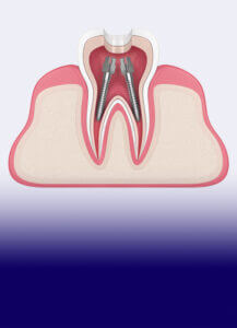 The James Clinic Dental Root Canal Treatment Image