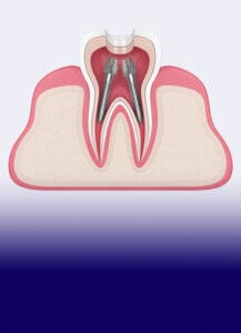 The James Clinic Dental Root Canal Treatment Image