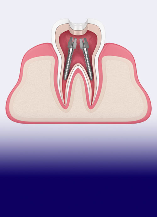 The James Clinic Dental Root Canal Treatment Image