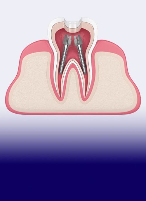 The James Clinic Dental Root Canal Treatment Image