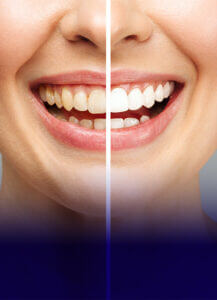 The James Clinic Teeth Whitening Treatment Image