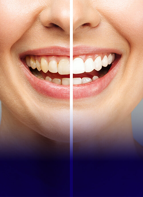 The James Clinic Teeth Whitening Treatment Image