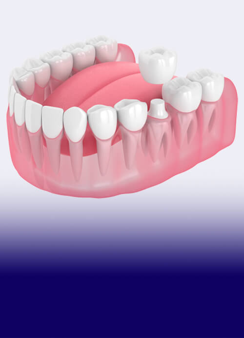 The James Clinic Dental Crown Treatment Image