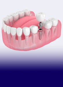 The James Clinic Dental Implants Treatment Image