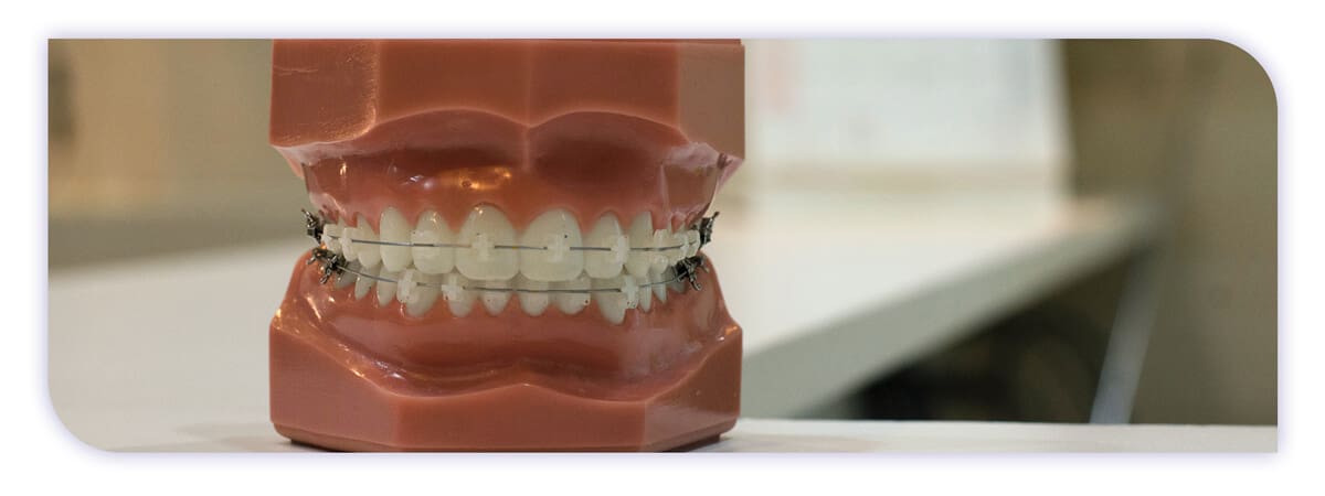 The James Clinic Blog Post Header Image alternatives to dental implants you can consider