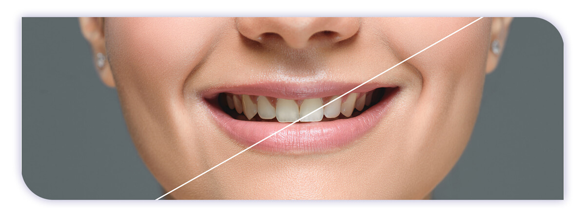 The James Clinic Blog Post Header Image how many teeth whitening sessions do you need