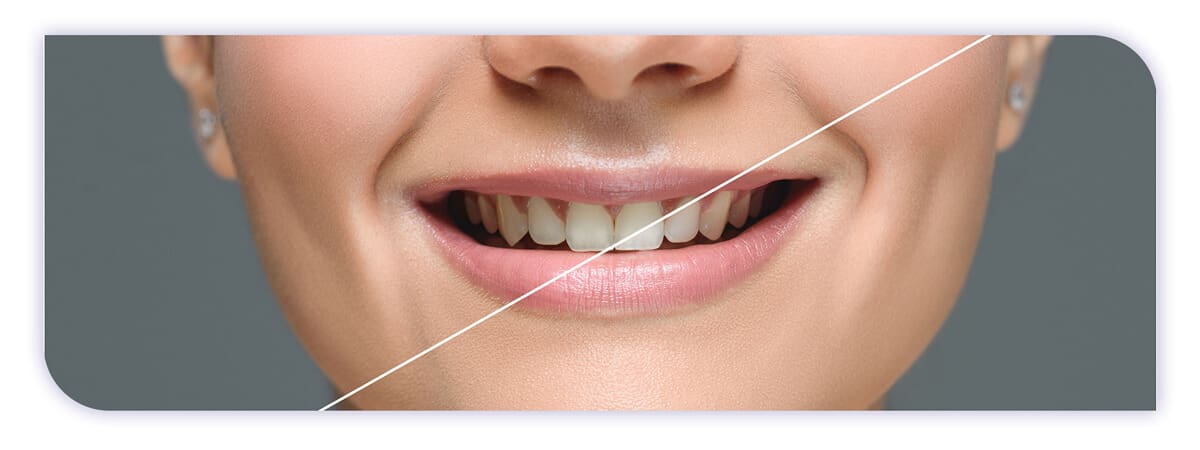 The James Clinic Blog Post Header Image how many teeth whitening sessions do you need