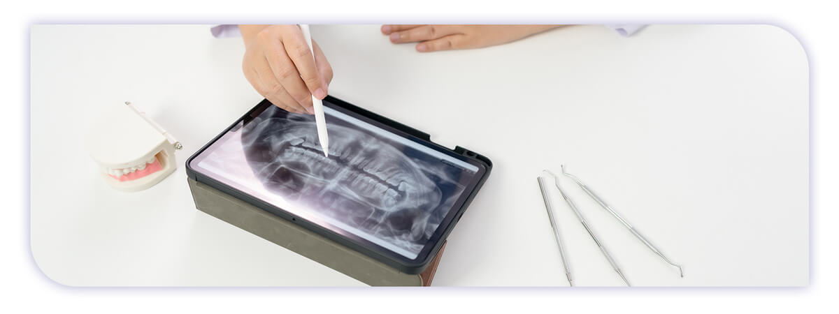 The James Clinic Blog Post Header Image how to mentally prepare for a root canal