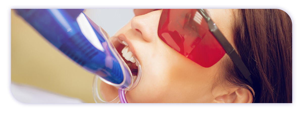 The James Clinic Blog Post Header Image laser teeth whitening and how it works