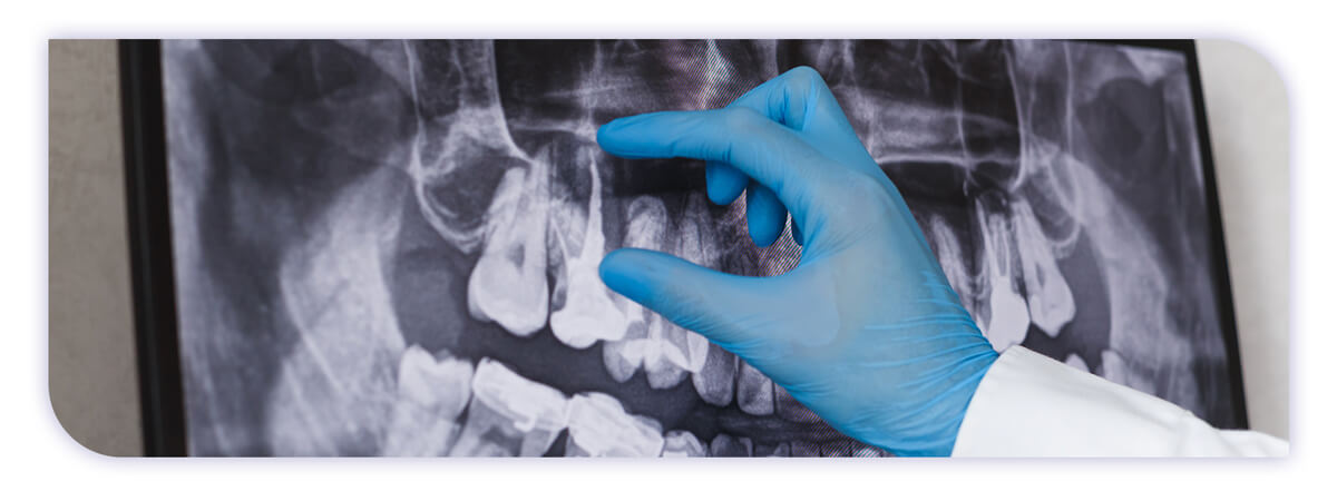 The James Clinic Blog Post Header Image root canal treatment how its done