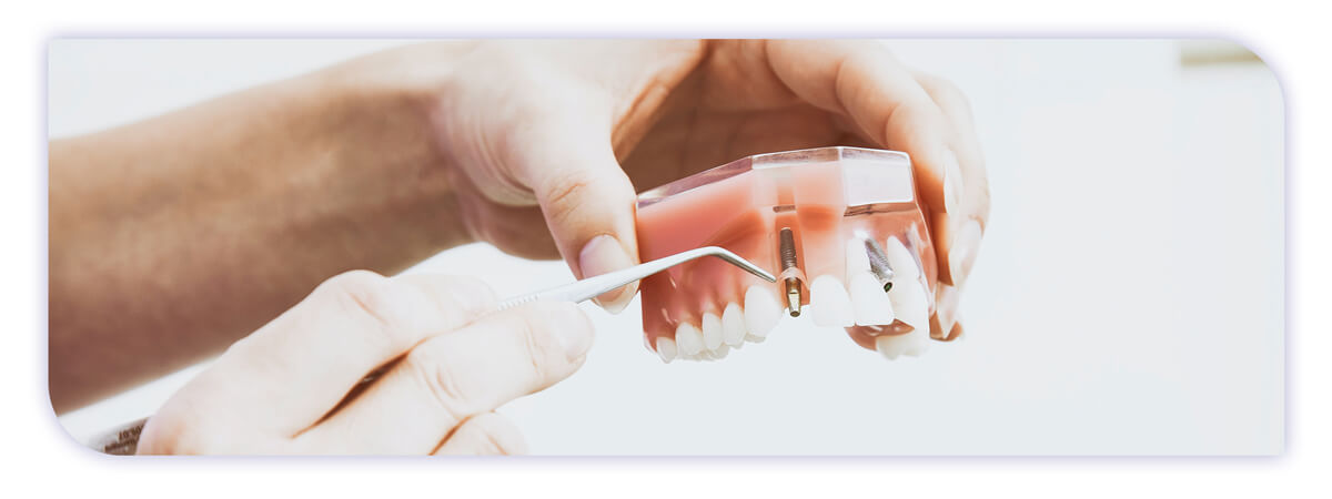 The James Clinic Blog Post Header Image what to do if you have dental implant problems years later